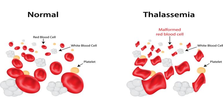 Thalassemia & Problem Jantung