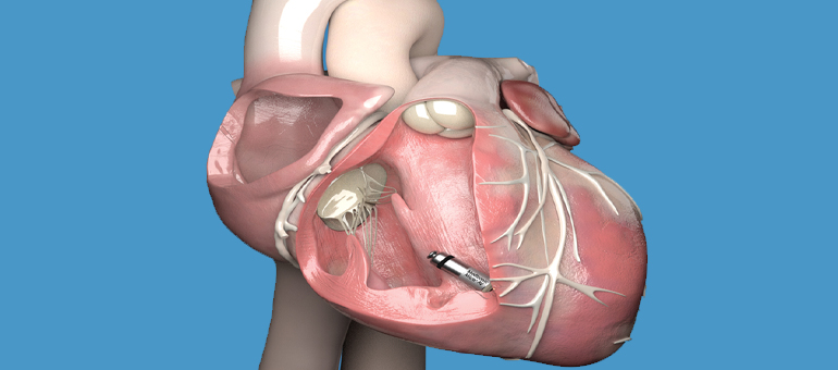 Pemasangan Alat Pacu Jantung Tanpa Operasi